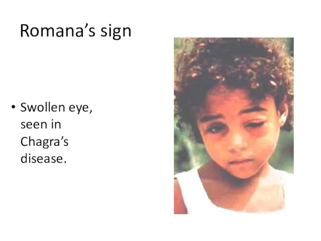 Romana’s sign Swollen eye, seen in Chagra’s disease.