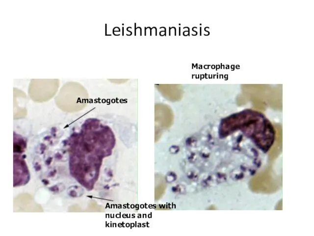 Leishmaniasis Amastogotes Amastogotes with nucleus and kinetoplast Macrophage rupturing