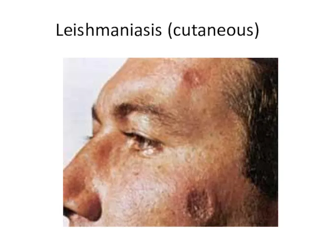 Leishmaniasis (cutaneous)