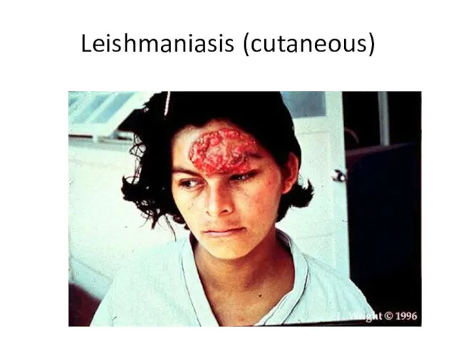 Leishmaniasis (cutaneous)