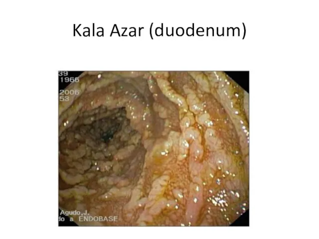 Kala Azar (duodenum)