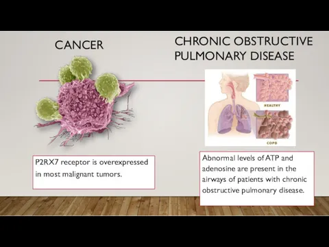 CANCER P2RX7 receptor is overexpressed in most malignant tumors. CHRONIC OBSTRUCTIVE PULMONARY DISEASE