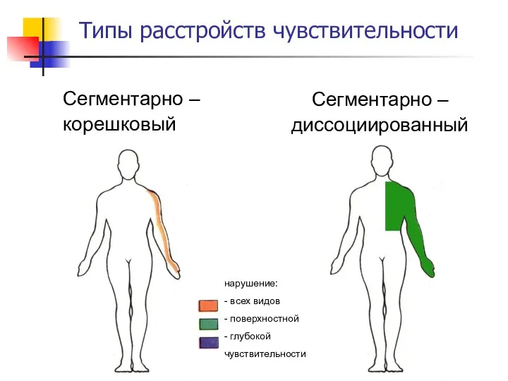 Типы расстройств чувствительности Сегментарно – корешковый Сегментарно – диссоциированный