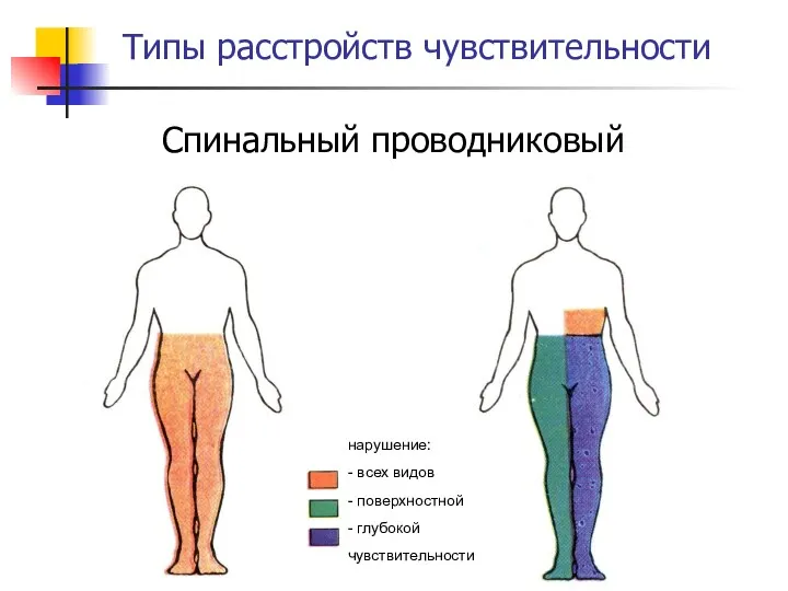 Типы расстройств чувствительности Спинальный проводниковый