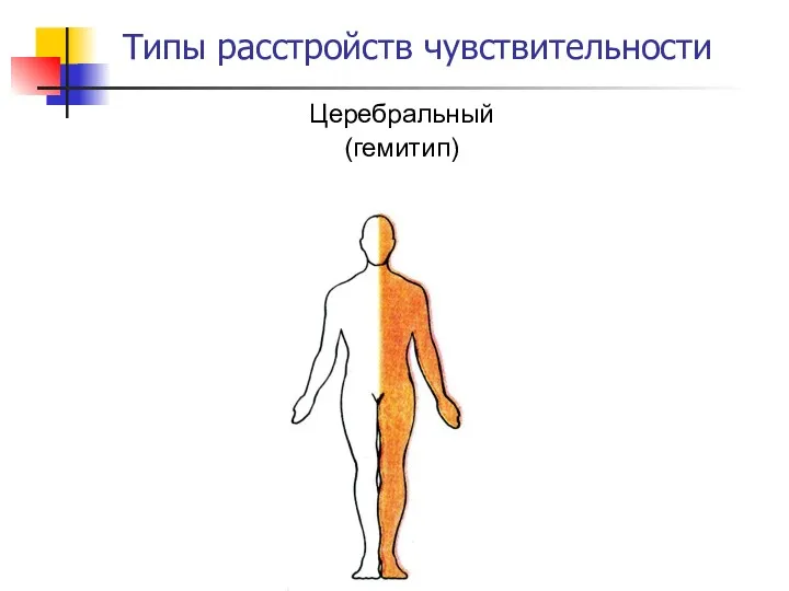 Типы расстройств чувствительности Церебральный (гемитип)