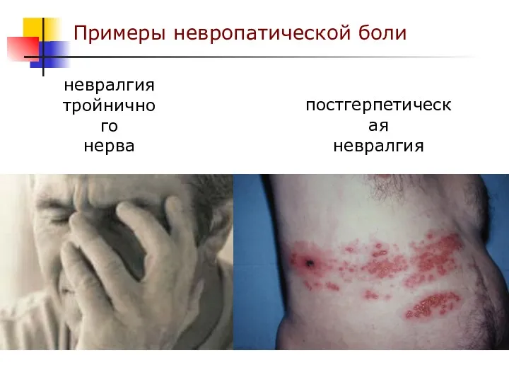 Примеры невропатической боли невралгия тройничного нерва постгерпетическая невралгия