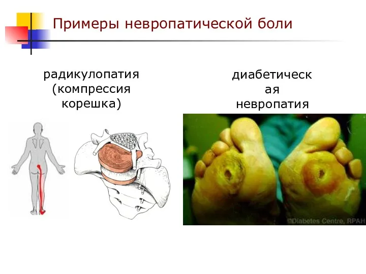 Примеры невропатической боли диабетическая невропатия радикулопатия (компрессия корешка)