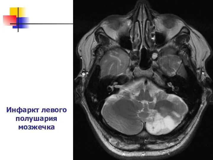 Инфаркт левого полушария мозжечка