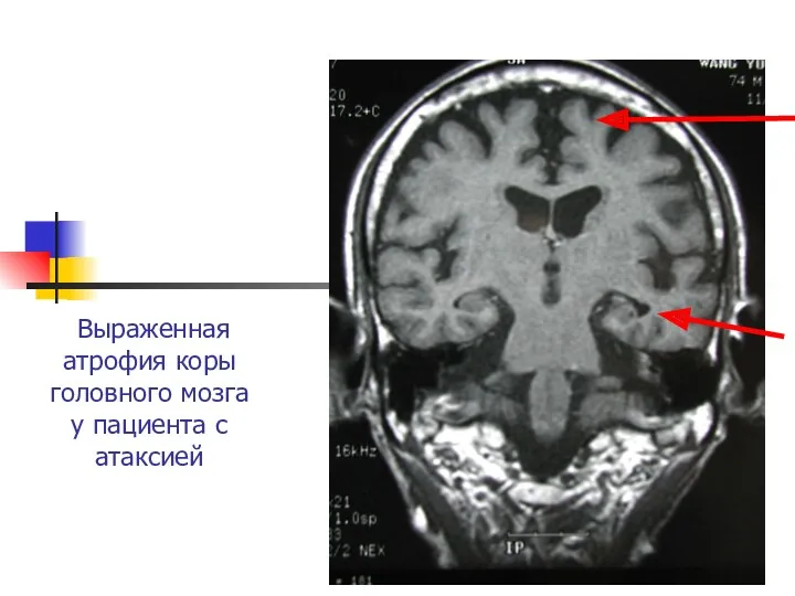 Выраженная атрофия коры головного мозга у пациента с атаксией