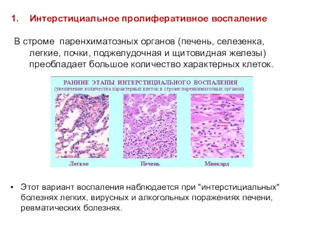 Интерстициальное пролиферативное воспаление В строме паренхиматозных органов (печень, селезенка, легкие, почки, поджелудочная и