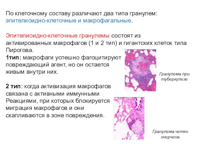По клеточному составу различают два типа гранулем: эпителиоидно-клеточные и макрофагальные. Эпителиоидно-клеточные гранулемы состоят