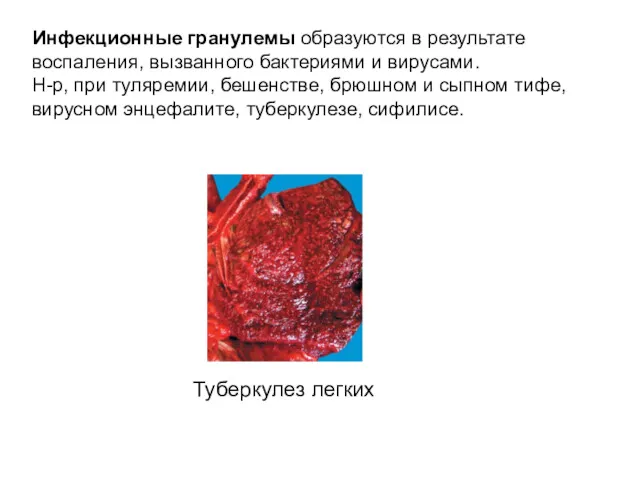 Инфекционные гранулемы образуются в результате воспаления, вызванного бактериями и вирусами. Н-р, при туляремии,