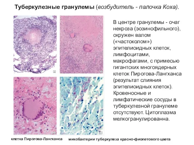 Туберкулезные гранулемы (возбудитель - палочка Коха). В центре гранулемы - очаг некроза (эозинофильного),