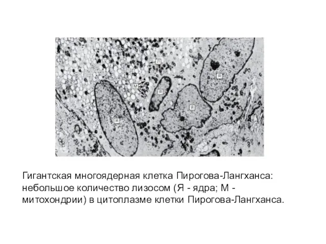 Гигантская многоядерная клетка Пирогова-Лангханса: небольшое количество лизосом (Я - ядра; М - митохондрии)