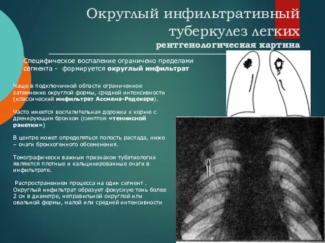 Округлый инфильтративный туберкулез легких рентгенологическая картина Чаще в подключичной области ограниченное затемнение округлой