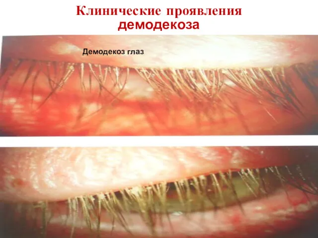 У человека преимущественно поражается кожа в области носогубных складок, носа, подбородка и век. Клинические проявления демодекоза