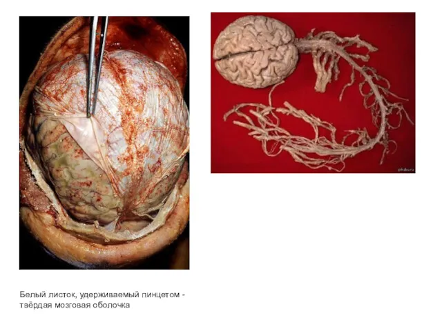 Белый листок, удерживаемый пинцетом - твёрдая мозговая оболочка