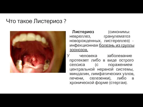 Что такое Листериоз ? Листериоз (синонимы: невреллез, гранулематоз новорожденных, листереллез)