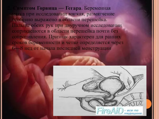 2. Симптом Горвица — Гегара. Беременная матка при исследовании мягкая,