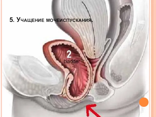 5. Учащение мочеиспускания.