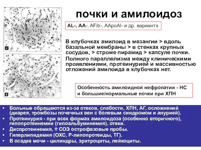 почки и амилоидоз В клубочках амилоид в мезангии > вдоль базальной мембраны >