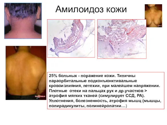 Амилоидоз кожи 25% больных - поражение кожи. Типичны параорбитальные подконъюнктивальные кровоизлияния, петехии, при