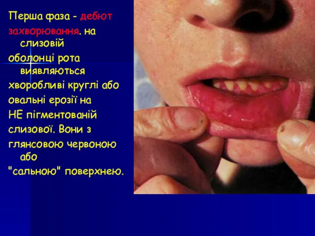 Перша фаза - дебют захворювання. на слизовій оболонці рота виявляються