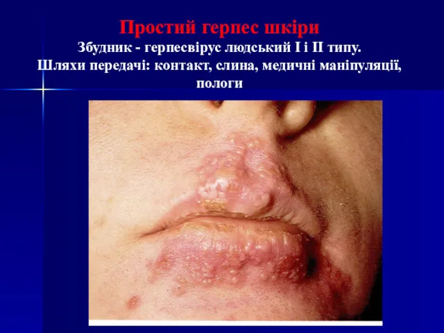 Простий герпес шкіри Збудник - герпесвірус людський I і II