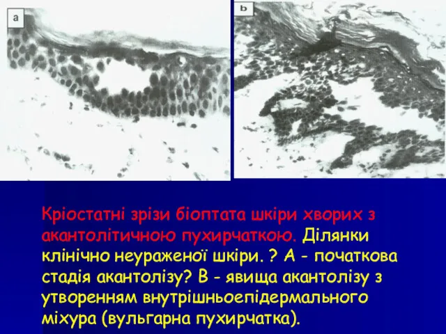Кріостатні зрізи біоптата шкіри хворих з акантолітичною пухирчаткою. Ділянки клінічно