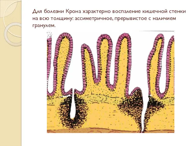 Для болезни Крона характерно воспаление кишечной стенки на всю толщину: ассиметричное, прерывистое с наличием гранулем.