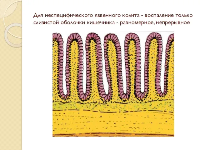 Для неспецифического язвенного колита - воспаление только слизистой оболочки кишечника - равномерное, непрерывное