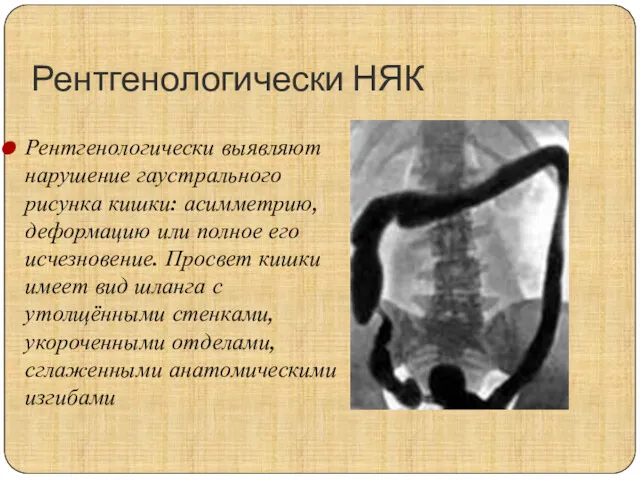 Рентгенологически НЯК Рентгенологически выявляют нарушение гаустрального рисунка кишки: асимметрию, деформацию
