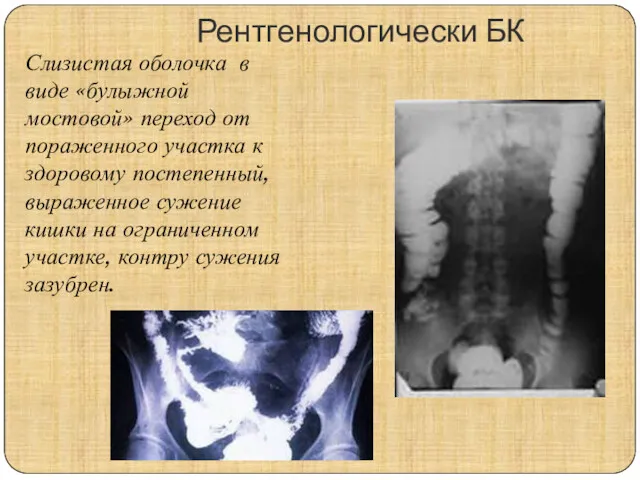 Рентгенологически БК Слизистая оболочка в виде «булыжной мостовой» переход от