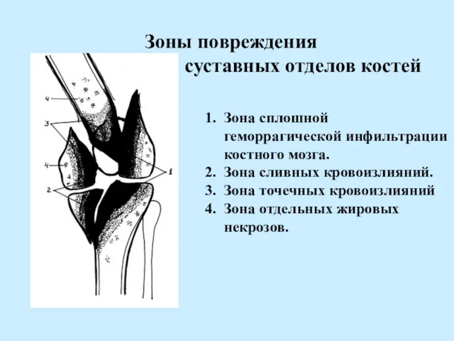 Зоны повреждения суставных отделов костей 1. Зона сплошной геморрагической инфильтрации