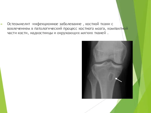 Остеомиелит –инфекционное заболевание , костной ткани с вовлечением в патологический