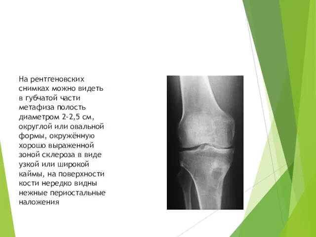 На рентгеновских снимках можно видеть в губчатой части метафиза полость