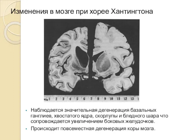 Изменения в мозге при хорее Хантингтона Наблюдается значительная дегенерация базальных