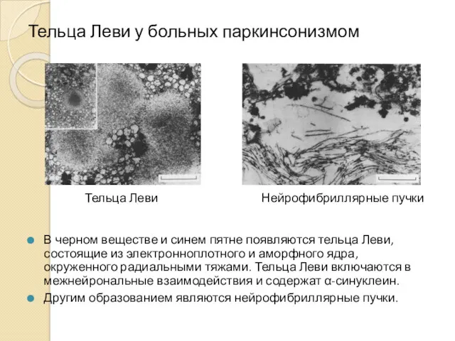 Тельца Леви у больных паркинсонизмом В черном веществе и синем