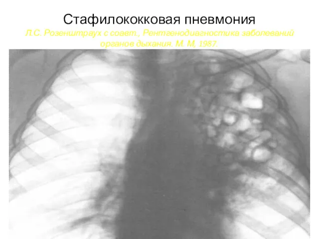 Стафилококковая пневмония Л.С. Розенштраух с соавт., Рентгенодиагностика заболеваний органов дыхания. М. М, 1987.