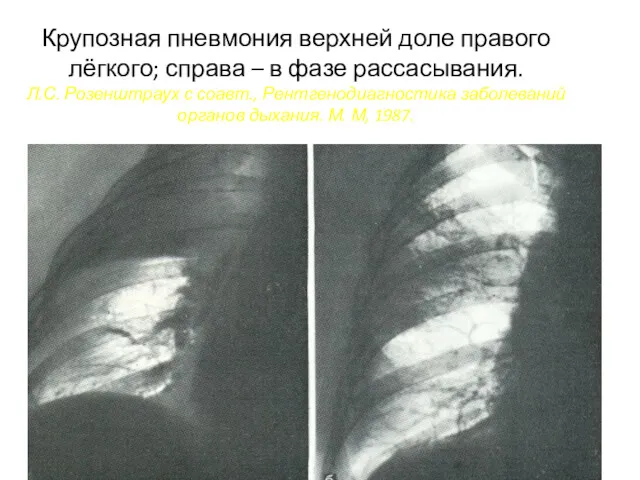 Крупозная пневмония верхней доле правого лёгкого; справа – в фазе