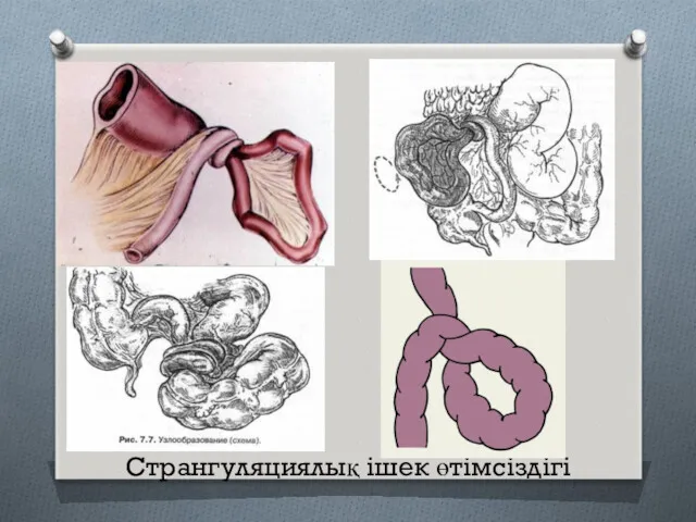 Странгуляциялық ішек өтімсіздігі