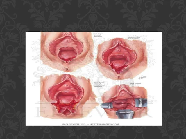 VAGINAL LACERATIONS