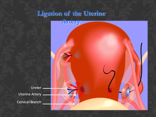 Ureter Ligation of the Uterine Artery Uterine Artery Cervical Branch