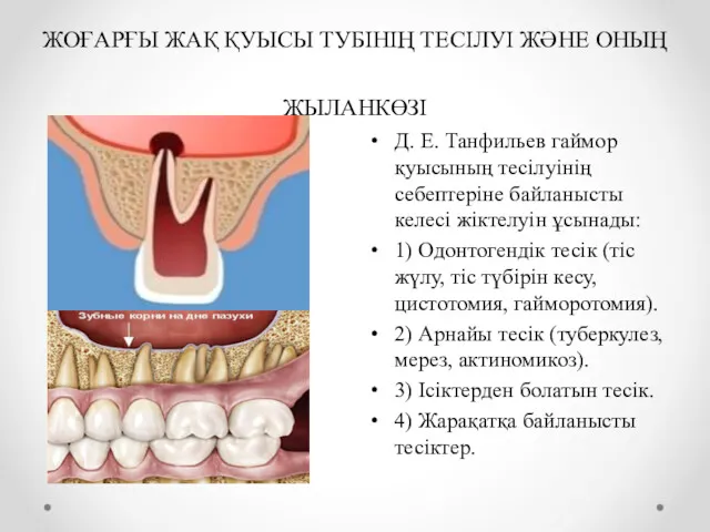 ЖОҒАРҒЫ ЖАҚ ҚУЫСЫ ТУБІНІҢ ТЕСІЛУІ ЖӘНЕ ОНЫҢ ЖЫЛАНКӨЗІ Д. Е.