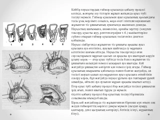 Кейбір науқастардың гаймор қуысында қабыну процесі кезінде, жоғарғы азу тістерін