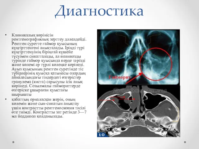 Диагностика Клиникалық көрінісін рентгенографиялық зерттеу дәлелдейді. Рентген суретте гаймор қуысының