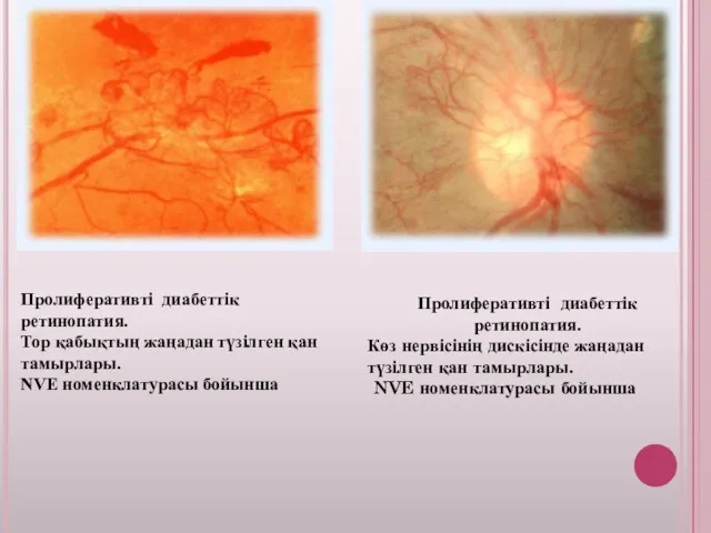 Пролиферативті диабеттік ретинопатия. Тор қабықтың жаңадан түзілген қан тамырлары. NVE