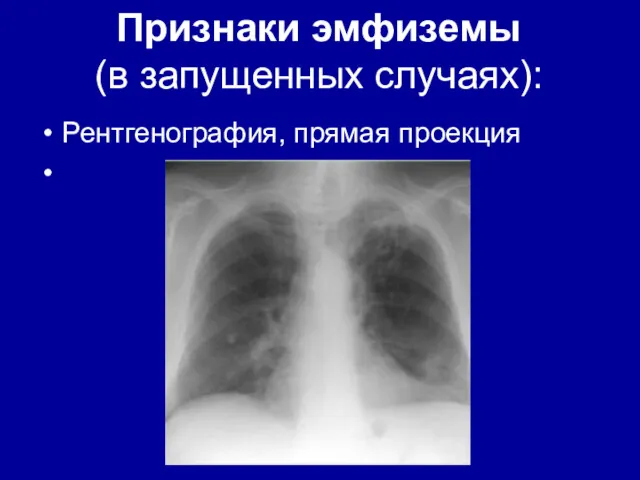 Признаки эмфиземы (в запущенных случаях): Рентгенография, прямая проекция