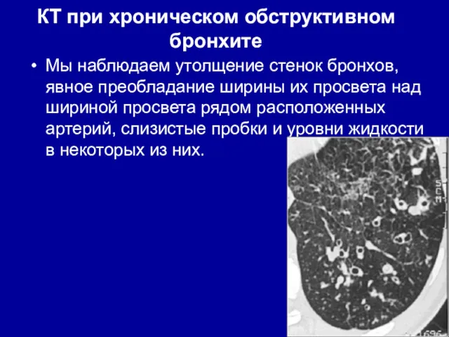 КТ при хроническом обструктивном бронхите Мы наблюдаем утолщение стенок бронхов,