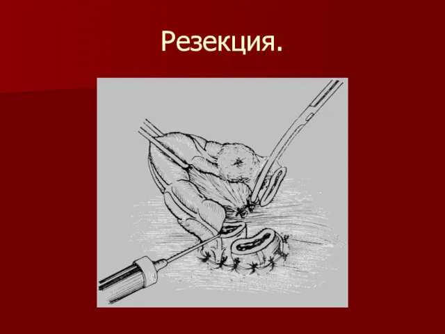 Резекция.